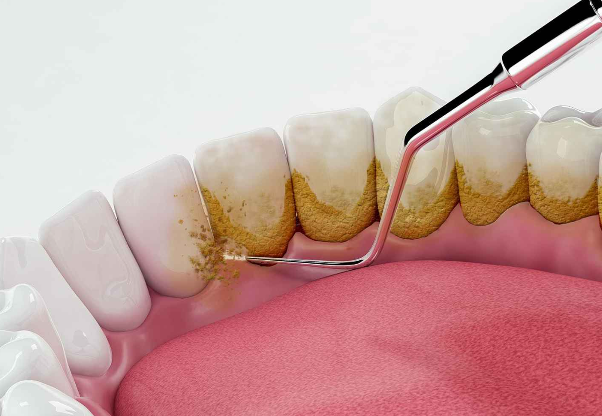 Cạo vôi răng bao lâu thì ăn được? Hướng dẫn chăm sóc răng miệng sau khi