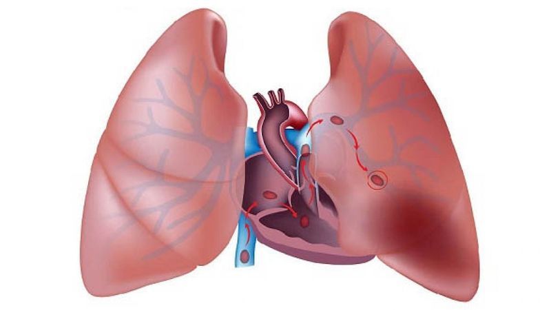 Hình minh họa một số bệnh lý thường gặp ở nhu mô phổi