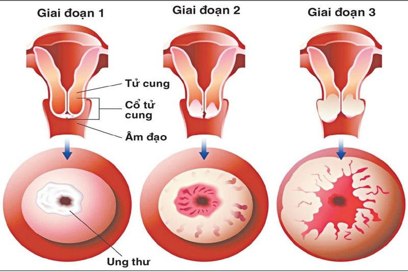 Nhận biết sớm các triệu chứng lâm sàng của ung thư cổ tử cung giai đoạn II 