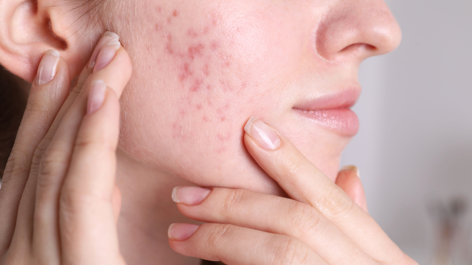 Mesotherapy có phù hợp với da mụn không?