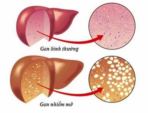 Kiểm soát biến chứng là mục tiêu quan trọng rạng rỡ để bảo vệ sự sống bền bỉ 