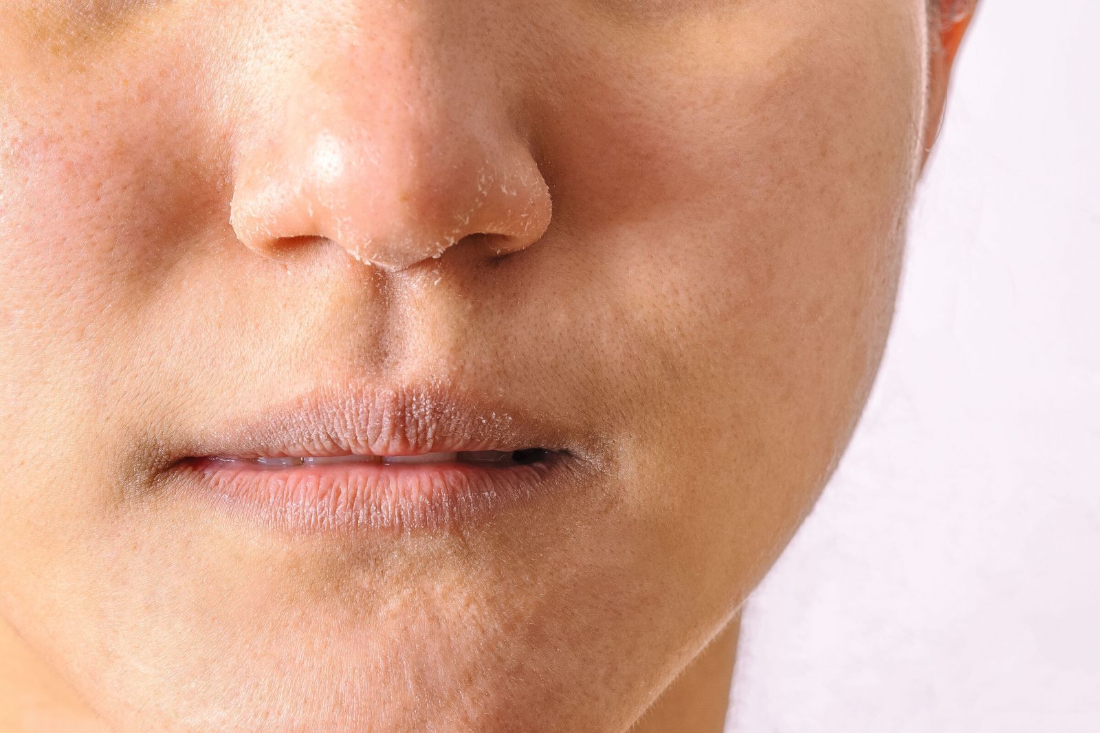 Tình trạng da mặt khô ráp, bong tróc vảy và sưng đỏ do viêm da cơ địa ở người lớn 