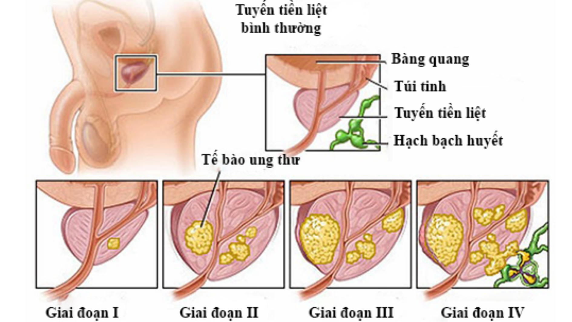 Các giai đoạn tiến triển của ung thư tuyến tiền liệt 