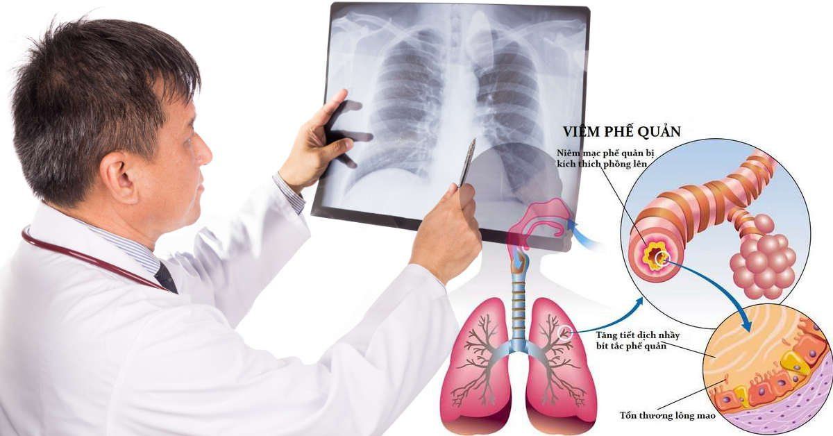 Hình minh họa một số bệnh lý phổi có thể gây ho kéo dài kèm đờm trắng
