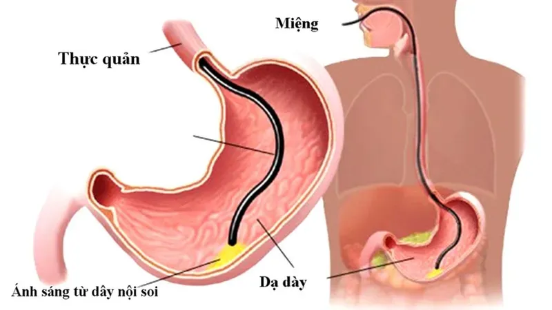 Nội soi dạ dày là kỹ thuật hàng đầu giúp phát hiện các tổn thương ác tính ở giai đoạn sớm 