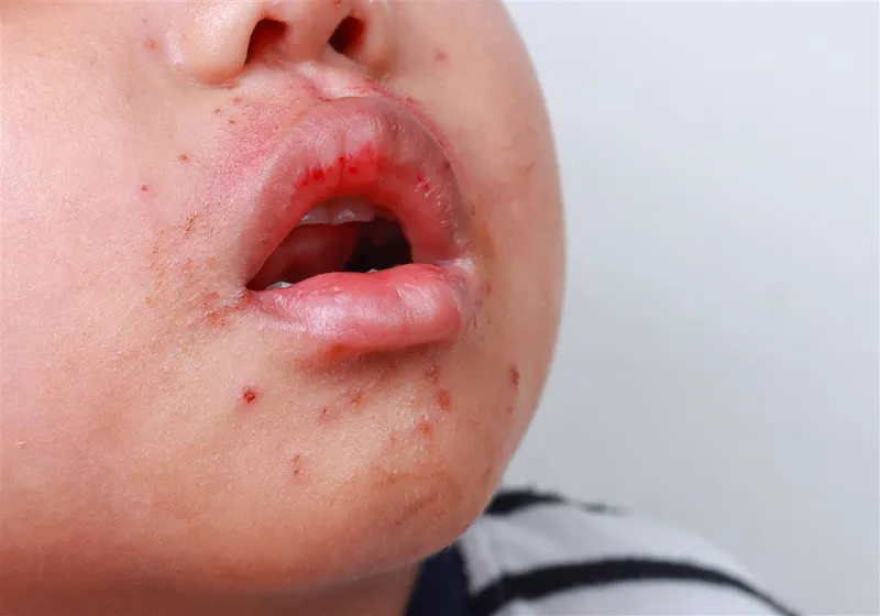 Theo dõi trẻ bị tay chân miệng giúp phát hiện sớm các dấu hiệu bất thường