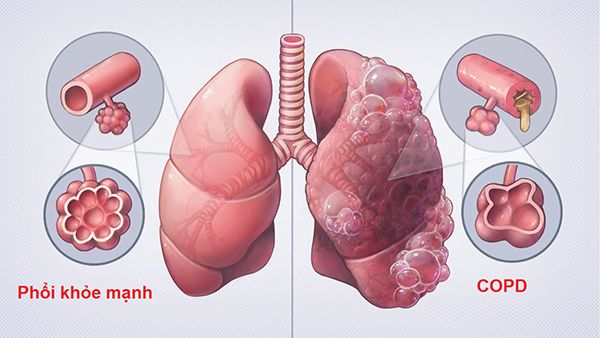Duy trì lối sống lành mạnh có thể giúp bảo vệ sức khỏe hệ hô hấp