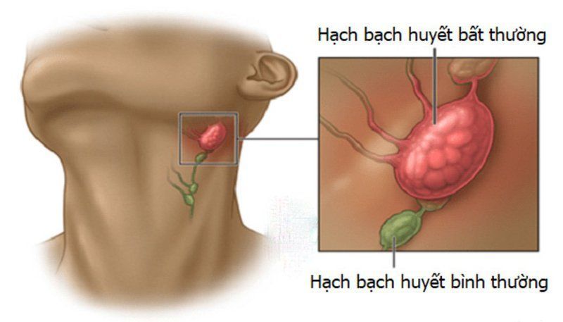 Cách phân biệt sưng hạch bạch huyết do HIV với các bệnh lý khác 