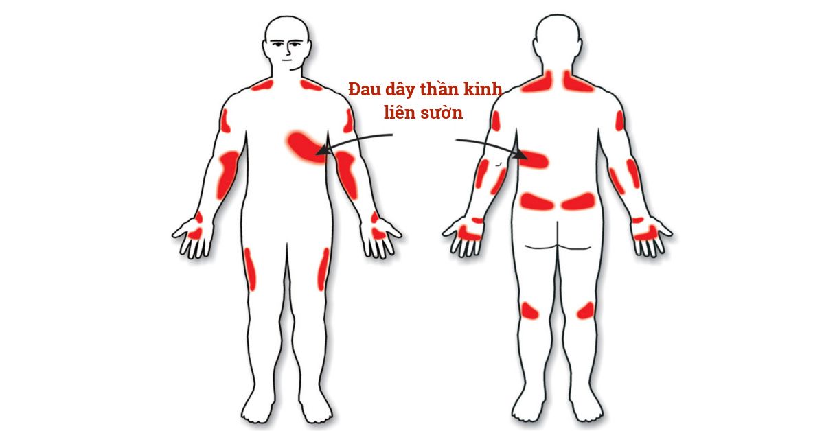 Hình minh họa cơn đau dây thần kinh liên sườn thường xuất hiện dọc theo khoang sườn và tăng khi vận động