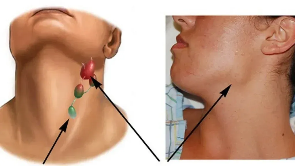 Hình minh họa vị trí ung thư hạch 
