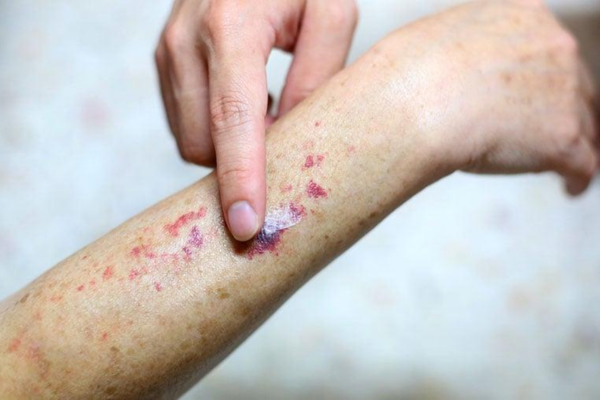 Ung thư máu có lây qua quan hệ hay không 