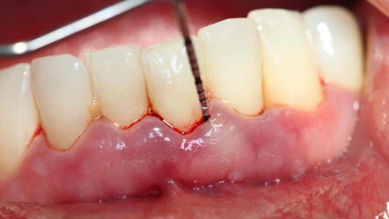 Các xét nghiệm hình ảnh hiện đại giúp bác sĩ đánh giá chính xác mức độ xâm lấn của khối u 