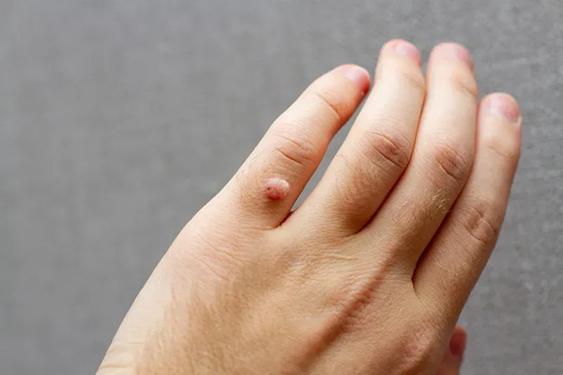 Các nốt mụn cứng trên tay thường có bề mặt sần và nhô cao trên da