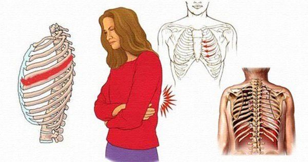 Hình minh họa vị trí dây thần kinh liên sườn trong khoang giữa các xương sườn