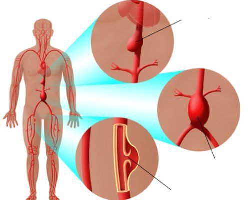 Hình minh họa siêu âm động mạch cảnh giúp quan sát lưu lượng máu và các bất thường tại động mạch cổ