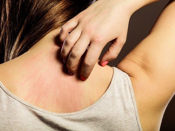 Hình minh họa các đặc trưng của bệnh phong ngứa trên bề mặt da