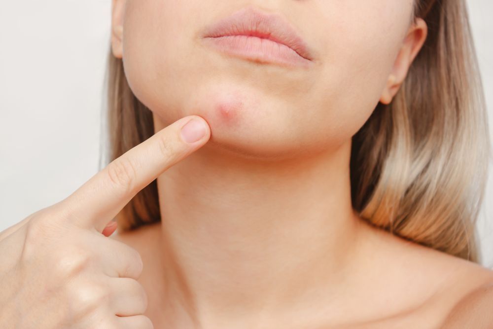 Lựa chọn mỹ phẩm phù hợp giúp hạn chế nguy cơ nổi mụn quanh miệng