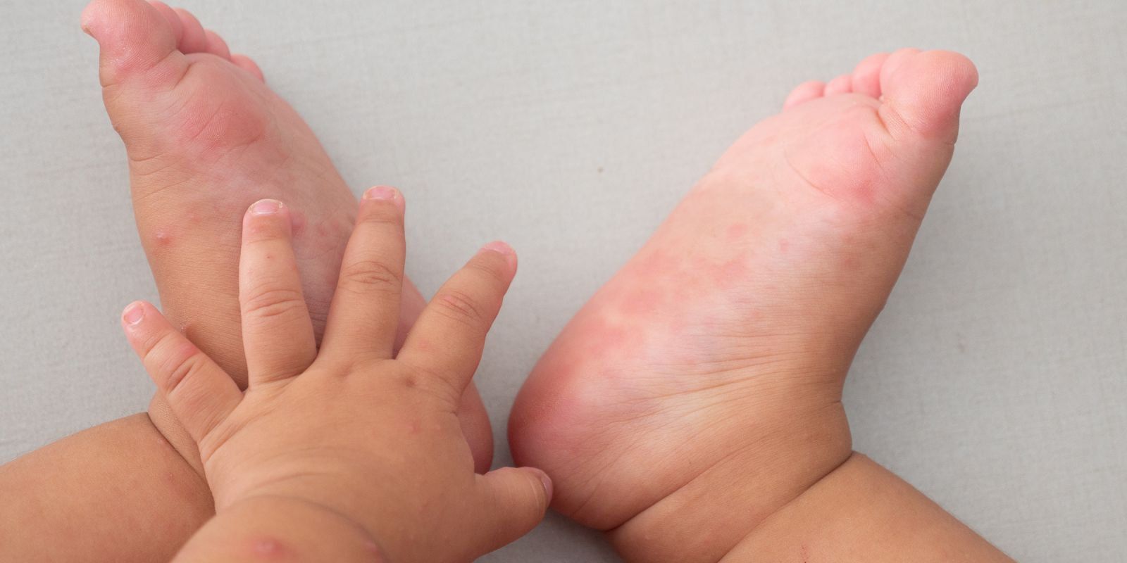 Ngứa lòng bàn chân có thể gây khó chịu và ảnh hưởng đến sinh hoạt hàng ngày