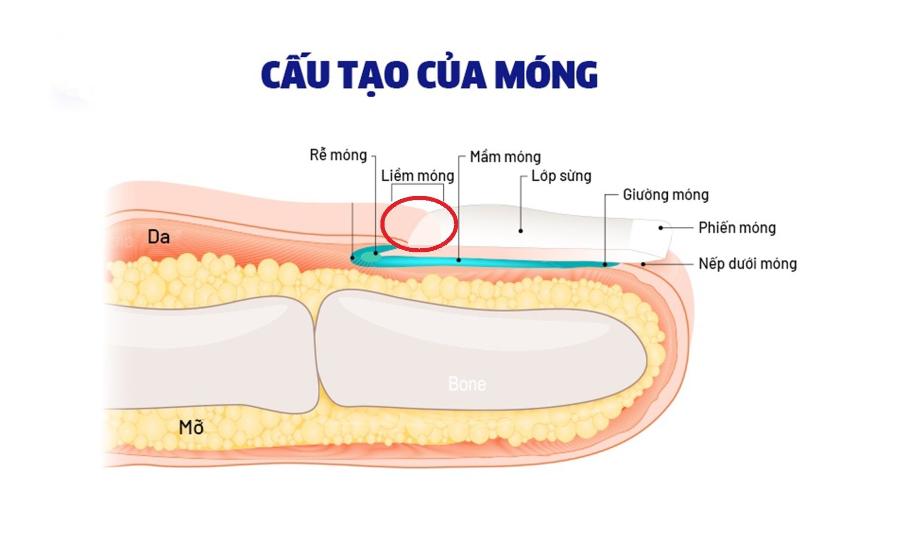 Móng chọc thịt xảy ra khi cạnh móng mọc cong và đâm vào da, gây sưng đau và khó chịu khi vận động.