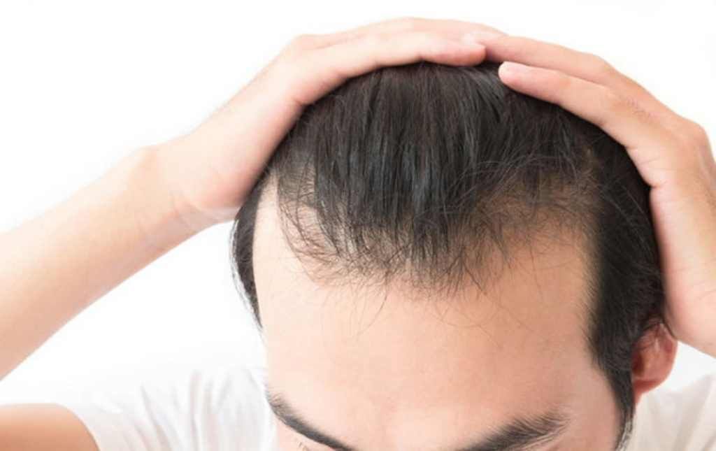 HÓI Ở ĐỈNH ĐẦU NỮ LÀM LỘ DA ĐẦU RÕ RỆT KHI CHẢI TÓC HOẶC SOI GƯƠNG