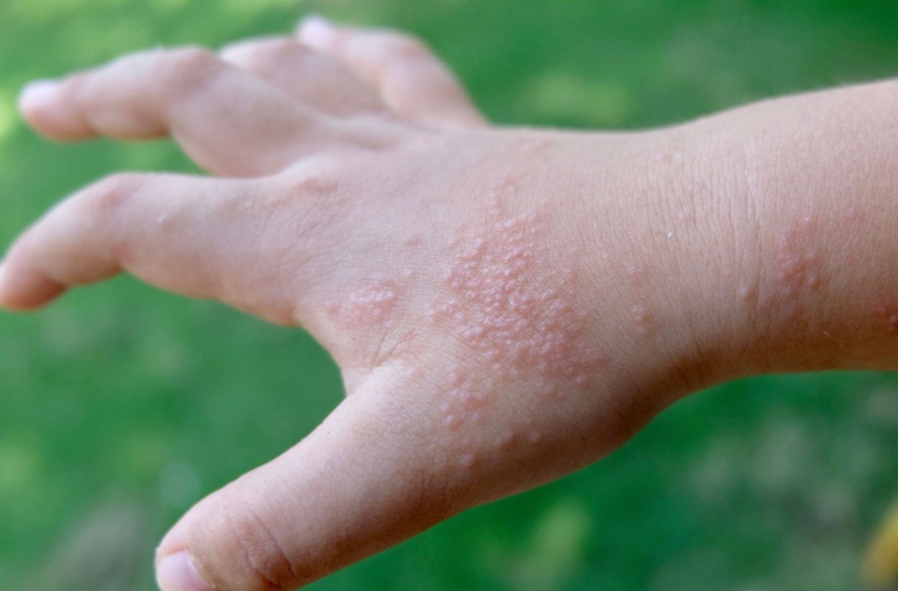 Tình trạng mụn nước ở tay có thể khởi phát do nhiều nguyên nhân bệnh lý và môi trường 