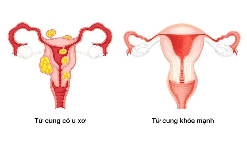 Các bệnh lý phụ khoa như u nang buồng trứng có thể gây đau buốt bụng dưới