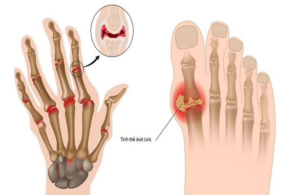 Chọc hút và phân tích dịch khớp là phương pháp mang lại độ chính xác tuyệt đối trong chẩn đoán gút 
