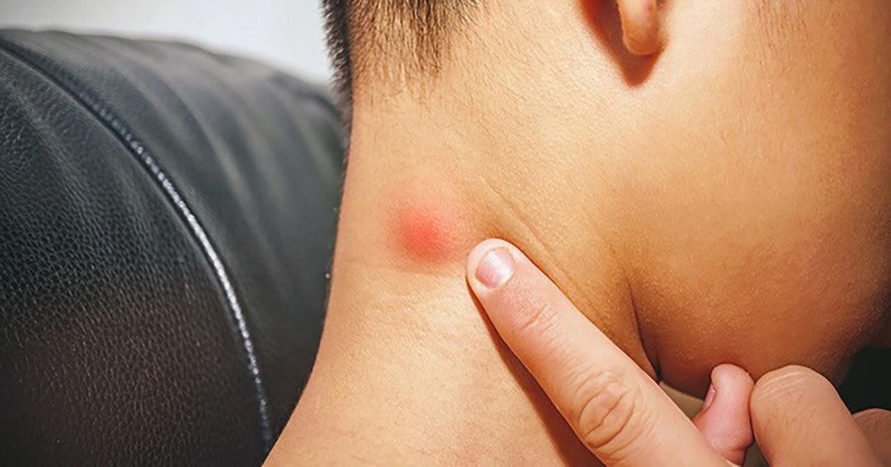 Nhiễm trùng đường hô hấp hoặc viêm họng có thể khiến hạch vùng cổ sưng to