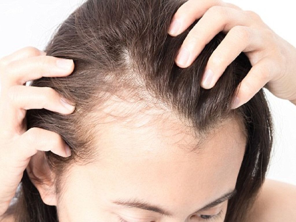 Lựa chọn dầu gội chứa hoạt chất kháng nấm là chìa khóa loại bỏ gàu và viêm da tiết bã da đầu 
