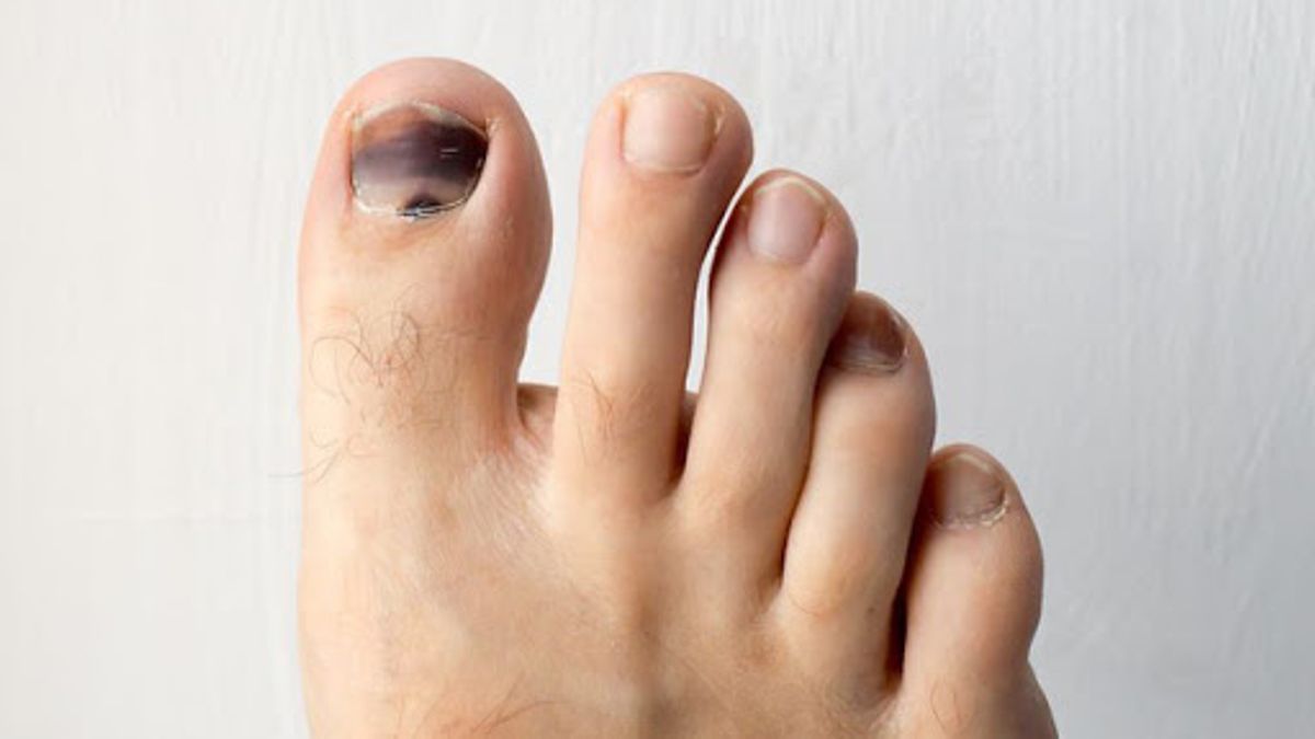 Nguyên nhân và cách xử lý móng chân bị đen: những điều cần biết để bảo