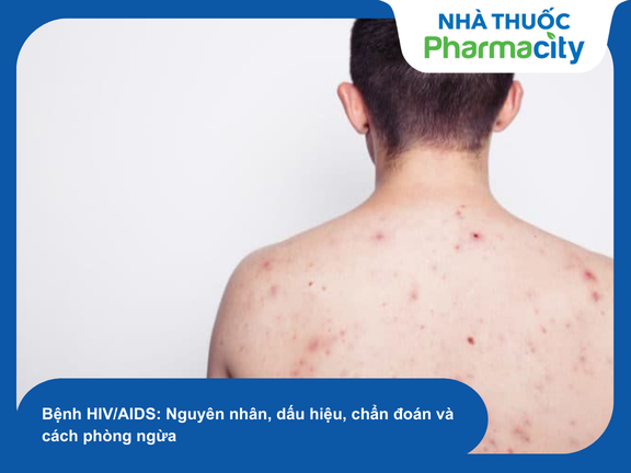 Đối tượng và yếu tố nguy cơ mắc Sida cần được chú trọng