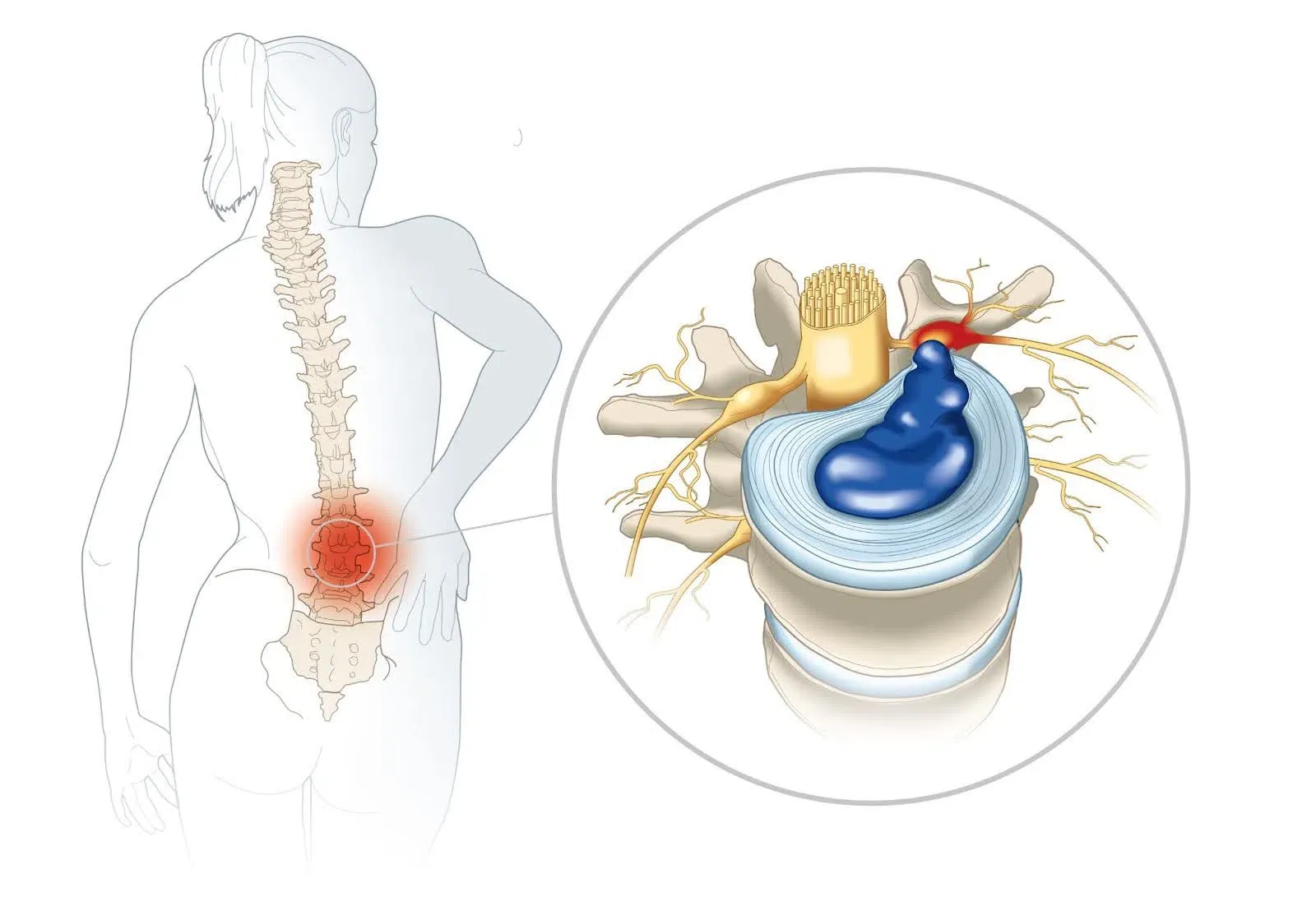 Chế độ dinh dưỡng giàu Omega-3 giúp ích cho điều trị viêm khớp