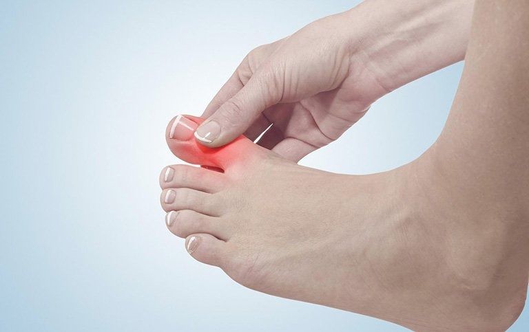 Triệu chứng điển hình nhất của bệnh gút là sự bùng phát đột ngột của các đợt viêm khớp cấp tính
