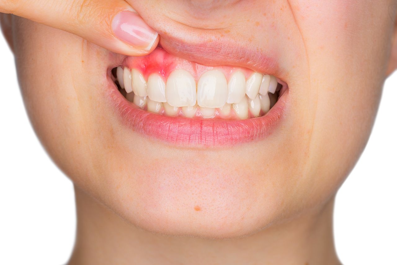 Chảy máu chân răng khi đánh răng có thể liên quan đến nhiều nguyên nhân khác nhau