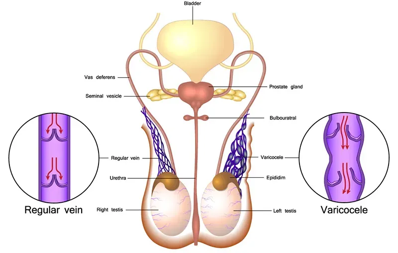 Hình minh họa cấu trúc hệ tĩnh mạch thừng tinh trong bìu