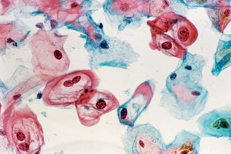 Hình minh họa tầm soát virus HPV nhằm phát hiện sớm nguy cơ tổn thương cổ tử cung