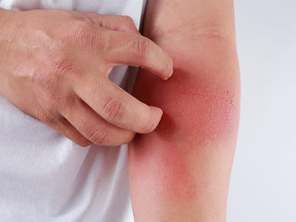 Biểu hiện mề đay trên da do dị ứng thời tiết.