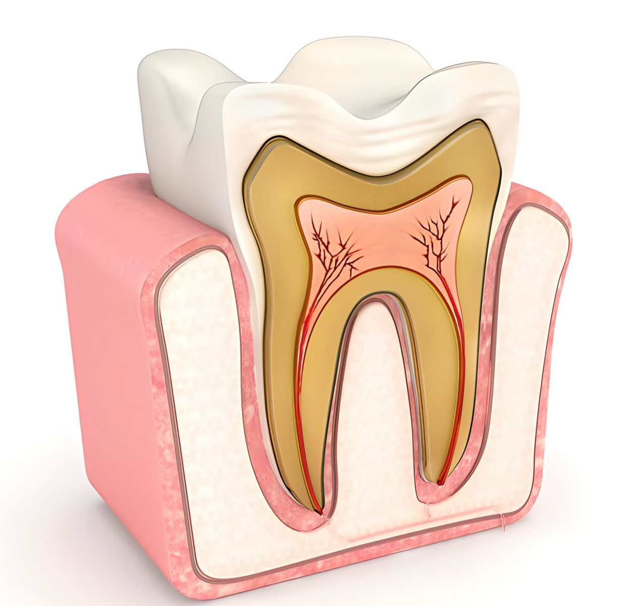 Bọc răng sứ giúp bảo vệ cấu trúc răng thật trước những vết nứt lớn 