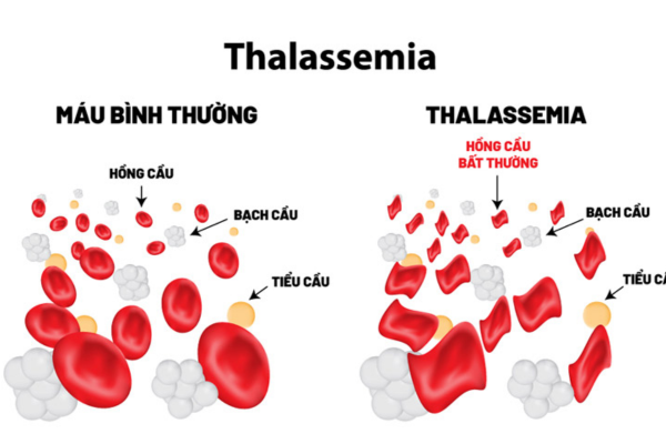 Xét nghiệm tổng phân tích tế bào máu của người chồng là bước đi tiên quyết trước khi lên kế hoạch mang thai 