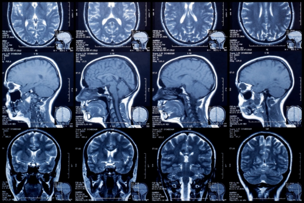 Chụp MRI sọ não là phương pháp cận lâm sàng có giá trị nhất giúp xác định chính xác tổn thương ở vùng hố sau và thân não
