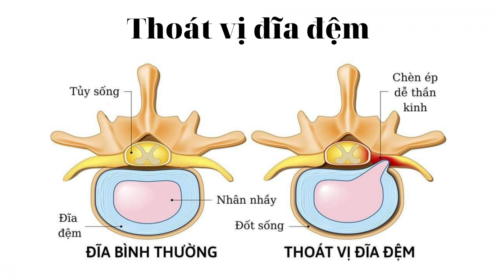 Cấu tạo cơ bản của cột sống gồm nhiều đốt sống, đĩa đệm và hệ thống dây thần kinh