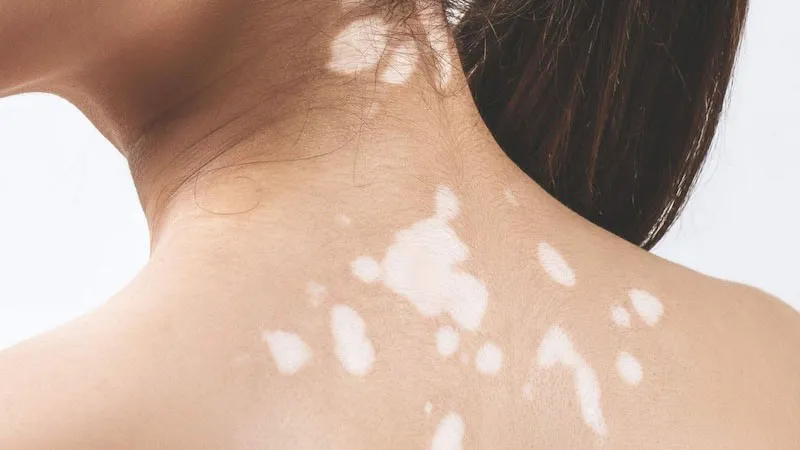 Bệnh bạch biến không lây từ mẹ sang con không qua đường mang thai hay sữa mẹ, nhưng có một tỷ lệ nhỏ liên quan đến yếu tố di truyền