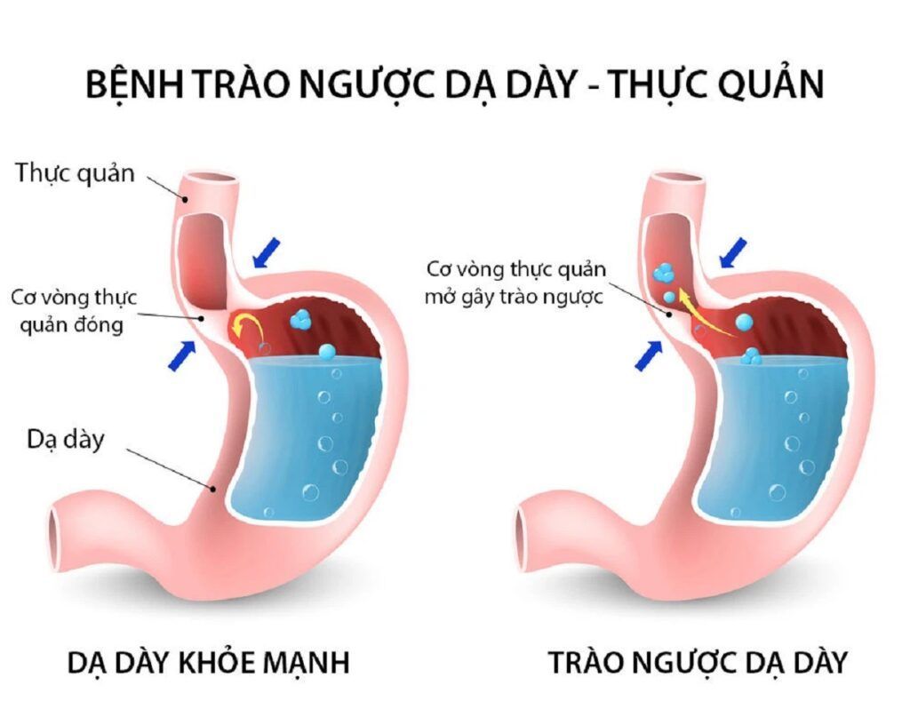 Trào ngược dạ dày xảy ra khi dịch vị từ dạ dày trào ngược lên thực quản