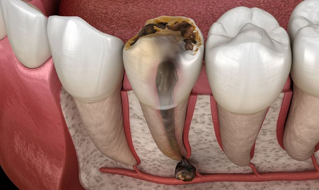 Đặt thuốc diệt tủy răng có đau không? những điều cần biết trước khi điều trị