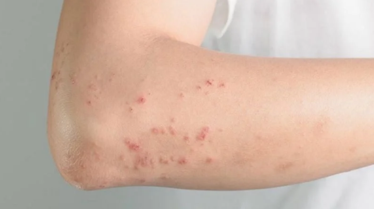 Ghẻ là gì? Những điều cần biết về ghẻ