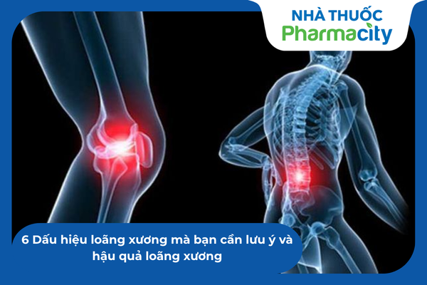 6 Dấu hiệu loãng xương mà bạn cần lưu ý và hậu quả loãng xương