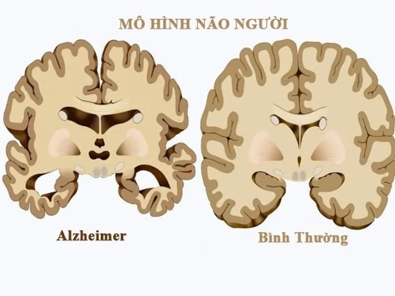 So sánh mô hình não người Alzeimer