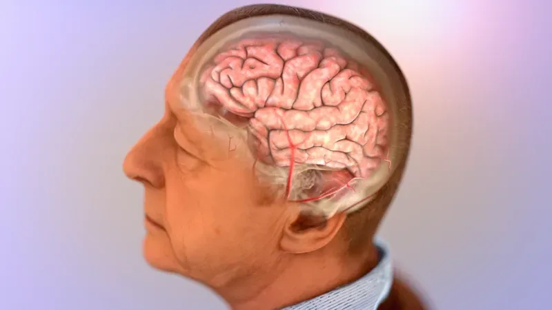 Yếu tố di truyền đóng vai trò khác nhau tùy thuộc vào thể bệnh Alzheimer khởi phát sớm hay muộn