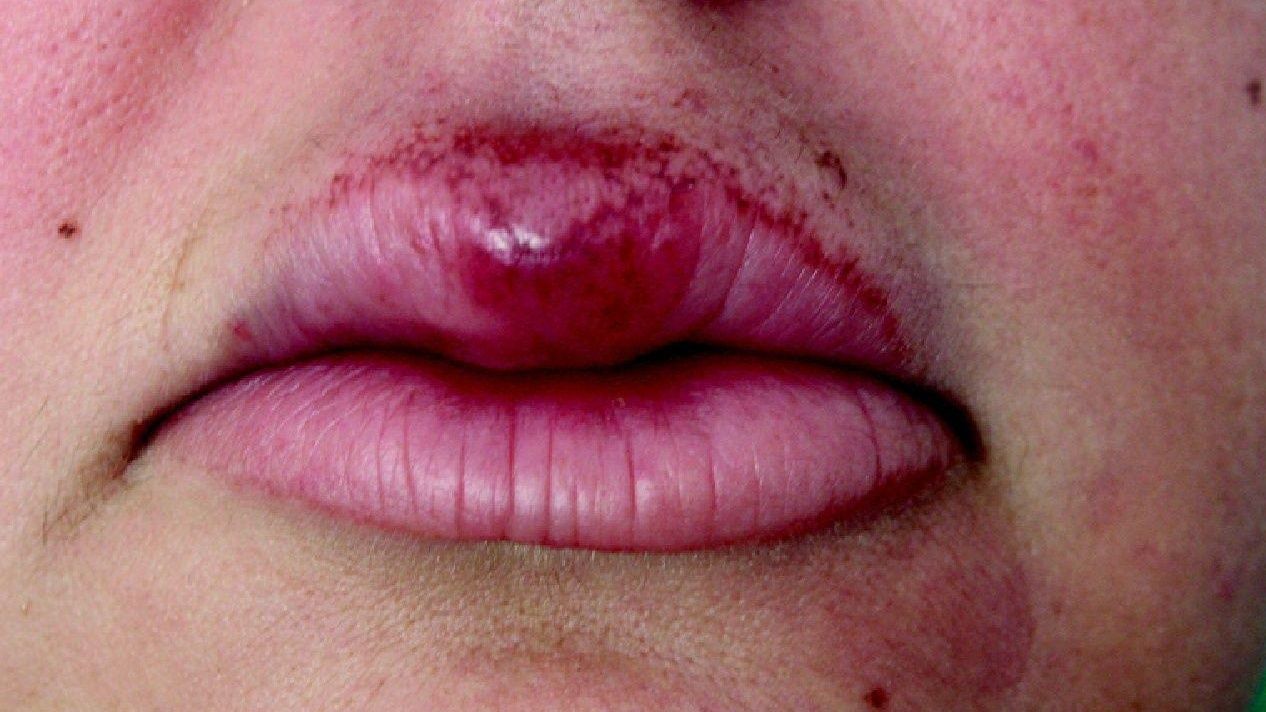 Mụn rộp do virus herpes có thể khiến môi nổi mụn nước và hạt nhỏ.