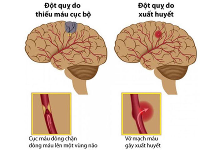 Đột quỵ